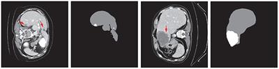 RA-UNet: A Hybrid Deep Attention-Aware Network to Extract Liver and Tumor in CT Scans